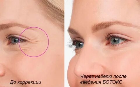 Ботокс после гв