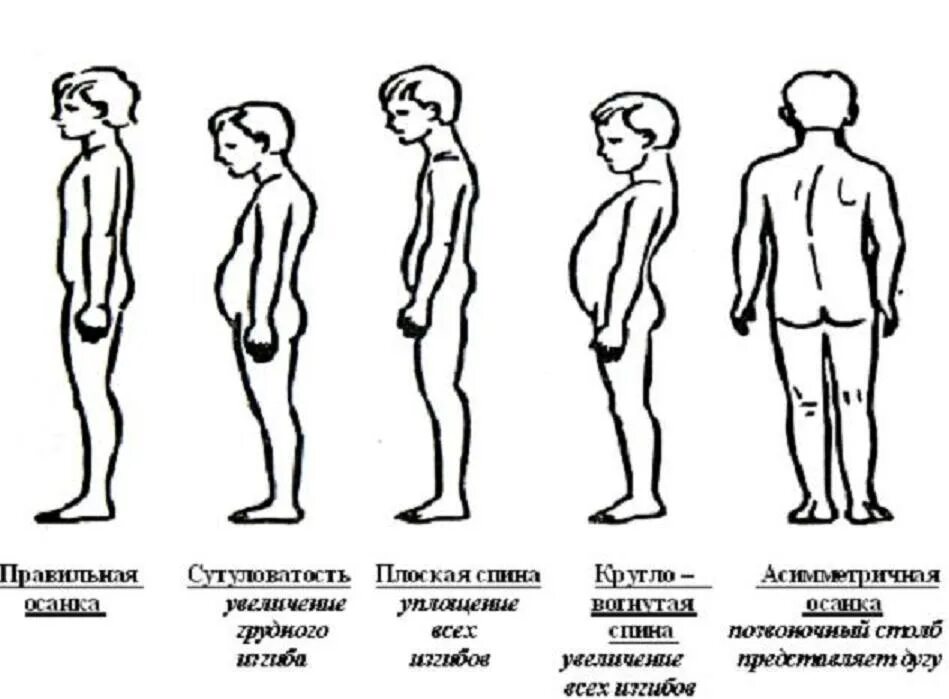 У ребенка в пояснице. Типы осанки у детей. Правильная осанка. Разновидности нарушения осанки. Нарушение осанки круглая спина.