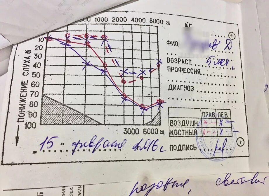 Аудиограмма при 3 степени тугоухости. Аудиограмма 4 степени тугоухости. Кондуктивная тугоухость 3 степени аудиограмма. Смешанная тугоухость 3 степени аудиограмма. Аудиограмма степени