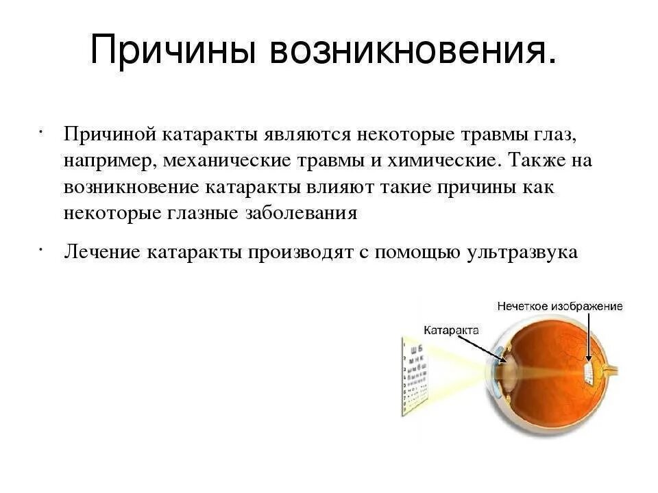 Причины развития катаракты. Передне капсулярная катаракта. Катаракта причины и профилактика. Катаракта глаза симптомы. После операции катаракты какие ограничения и сроки