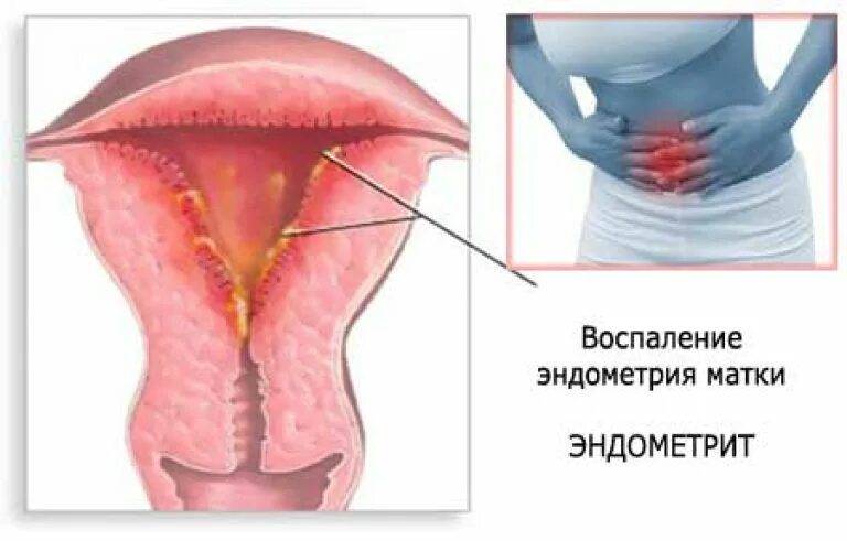 Воспаление внутренней оболочки матки. Воспалительные заболевания эндометрит. Воспаление матки эндометрит. Хронический эндометрит на фоне ВМС.