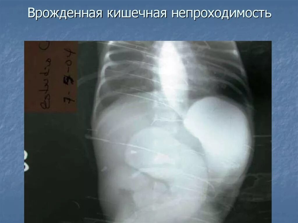 Кишечная непроходимость это. Интраорганная кишечная непроходимость. тромбоэмболическая кишечная непроходимость. ирригография кишечная непроходимость. врожденная кишечная непроходимость.