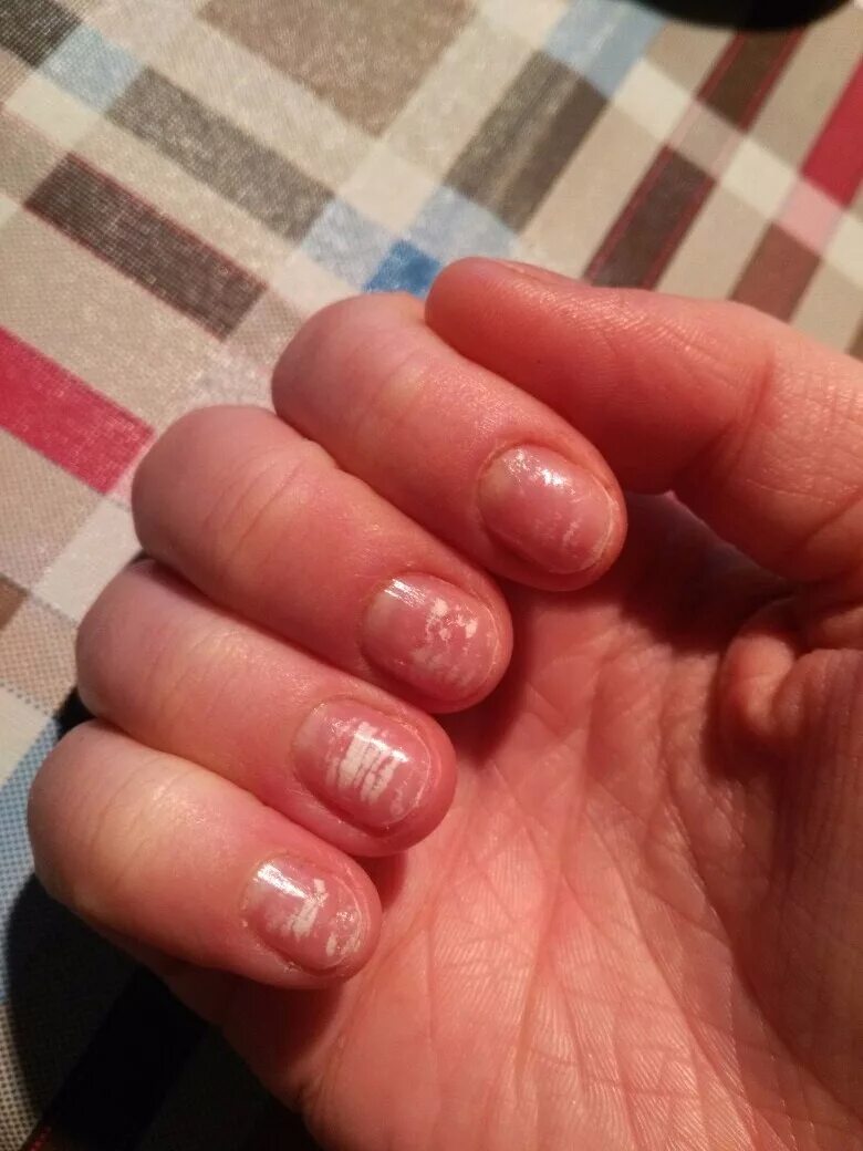 Что значат полосы на ногтях. Белии палости на ногтях. Белые горизонтальные полоски на ногтях рук.