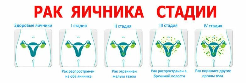 Эндометриоидная киста яичника мрт. Победившие рак яичников. Победившие рак яичников. Стадии опухоли яичника. Метастазирование опухоли яичника.