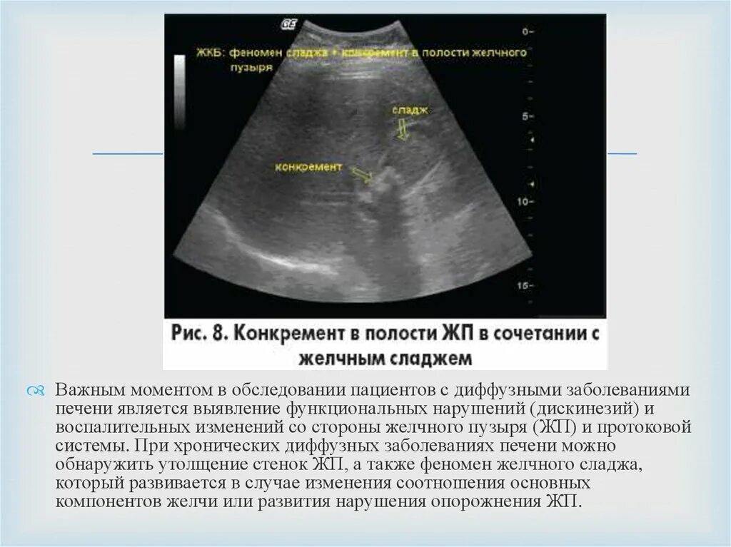 Умеренно диффузные изменения печени и поджелудочной железы. Передняя стенка желчного пузыря на УЗИ. Изменения стенки желчного пузыря на УЗИ. Утолщение стенки желчного пузыря на УЗИ. Жировая инфильтрация желчного пузыря.