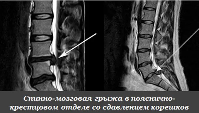 Грыжи поясничного отдела позвоночника у женщин. Грыжа пояснично-крестцового отдела. Грыжа позвонка поясничного отдела 6 мм. Междисковая грыжа поясничного отдела. Межпозвоночная грыжа пояснично-крестцового 9мм.