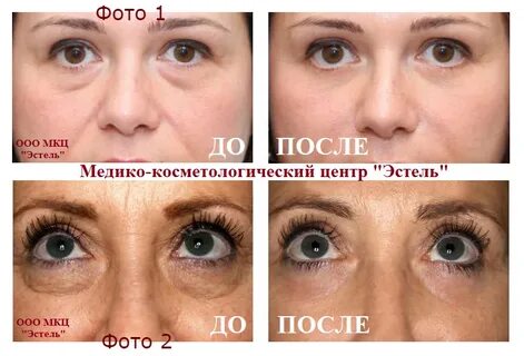 Мезотерапия глаз до и после отзывы
