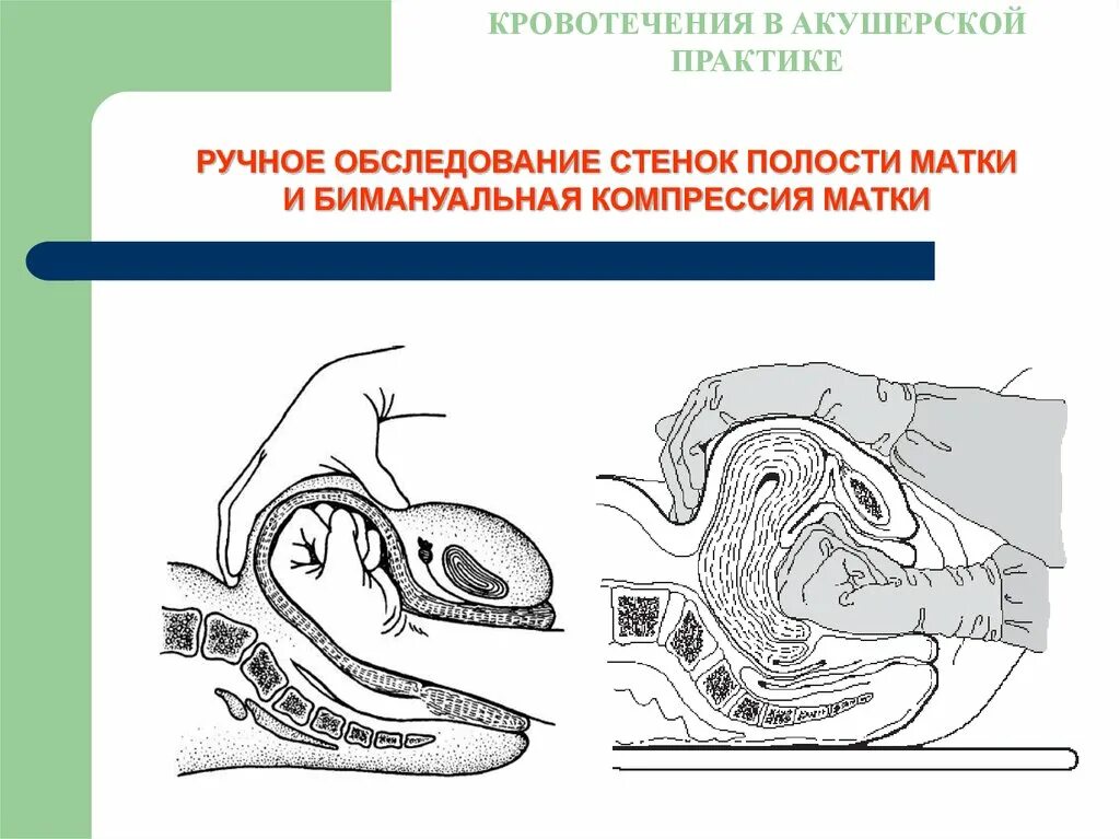 Ручное обследование полости матки. Ручное обследование стенок послеродовой матки. Ручное обследование матки алгоритм. Ручное обследование полости матки алгоритм.