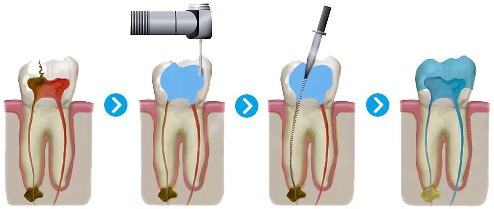 Этапы препарирования эндодонтии. Эндодонтия в стоматологии этапы. Этапы эндодонтического лечения
