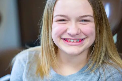 What Do The Elastic Rubber Bands On Braces Do? 