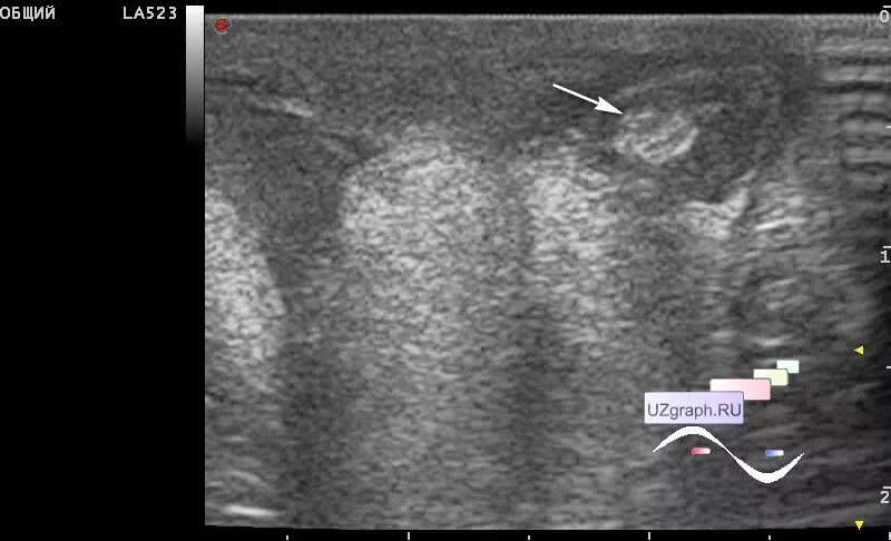 Крипторхизм и монорхизм. Яичко в паховом канале на УЗИ.