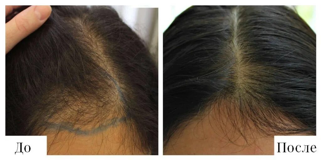 Для роста новых волос. Волосы после лучевой терапии. Рост новых волос. Рост новых волос на голове. Неправильный рост волос.