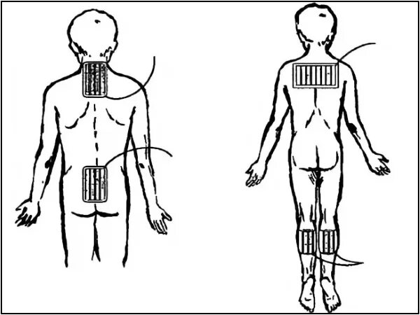 Брома на воротниковую зону. Общая гальванизация по Вермелю. Электрофорез тазобедренного сустава методика. Методика Вермеля электрофорез. По Вермелю электрофорез методика детям.