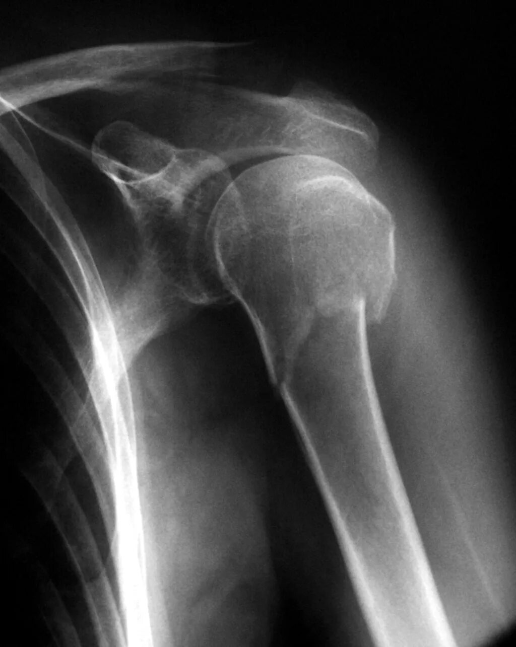 Перелом плечевой кости рентген. Перелом большого бугорка плечевой кости рентген. Большой бугорок плечевой кости рентген. Субкапитальный перелом шейки плечевой кости.