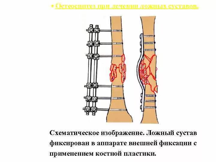 Классификация ложных суставов. Возникновение ложного сустава. Остеосинтез при псевдоартрозе. Киров суставы операции