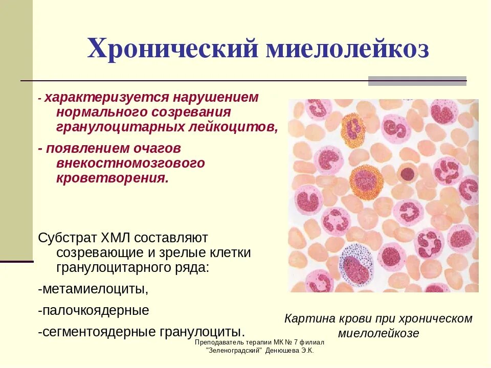 Болезнь миелолейкоз. Хронический миелолейкоз (хмл) лейкоз. хронический миелолейкоз показатели лейкоцитов. миелоцитарный лейкоз картина крови. миелоидный лейкоз картина крови.