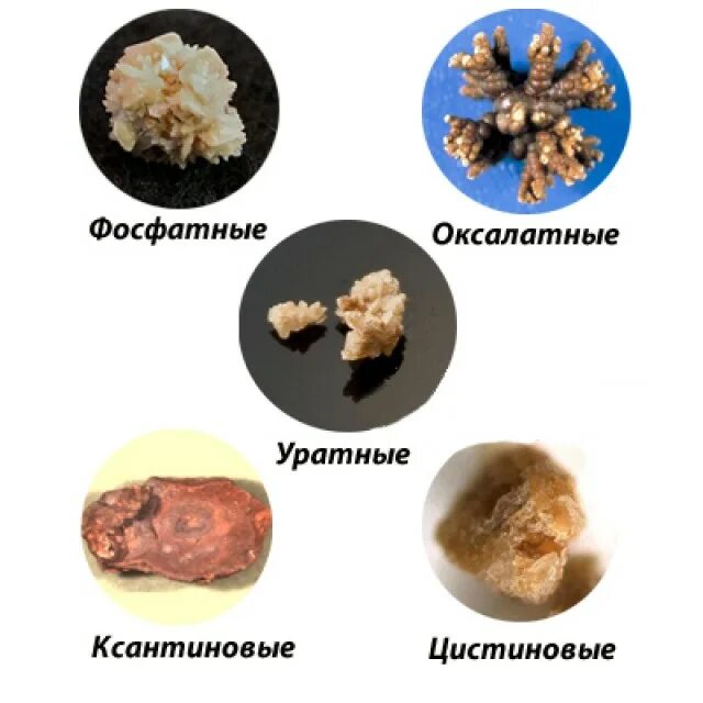 Растворение мочевого камня. Разновидности камней в почках. Оксалатные камни в почках вид. Мочекаменная болезнь цистиновые камни. Камни оксалаты фосфаты Ураты.