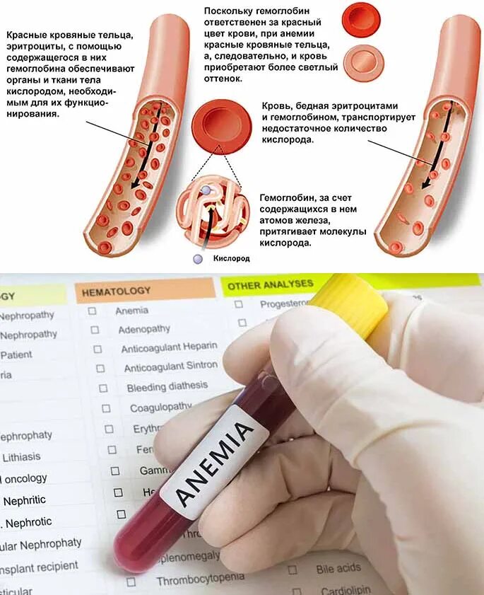 Причины анемии крови. Железодефицитная анеми. Железодефицитная анемия проявления. Железодифицитная Анимия. Признаки железодефицитной анемии.