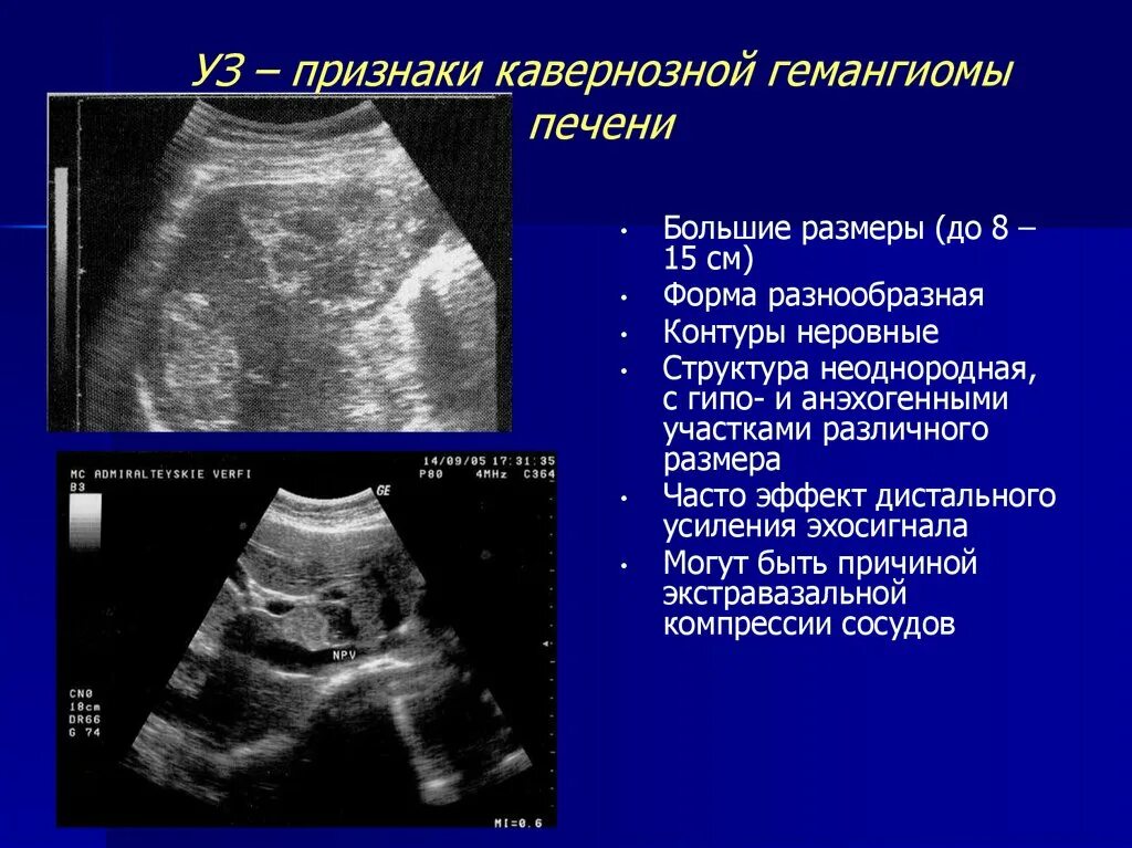 Образование в правой доле печени. Кавернозная гемангиома печени на УЗИ. Гемангиома печени УЗИ признаки. Гемангиомы печени при УЗИ характеризуются. УЗИ признаки опухоли печени.