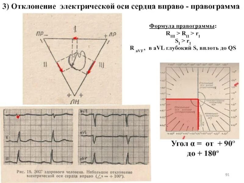 Синусовый ритм отклонение эос. Отклонение эл оси вправо экг. эос отклонена вправо на экг. отклонение оси на экг. электрическая ось вправо на экг.
