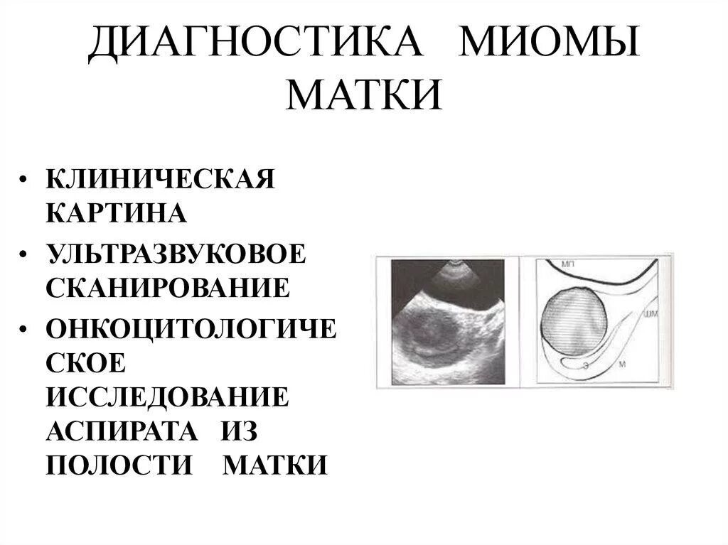 Симптомы миомы матки у женщин