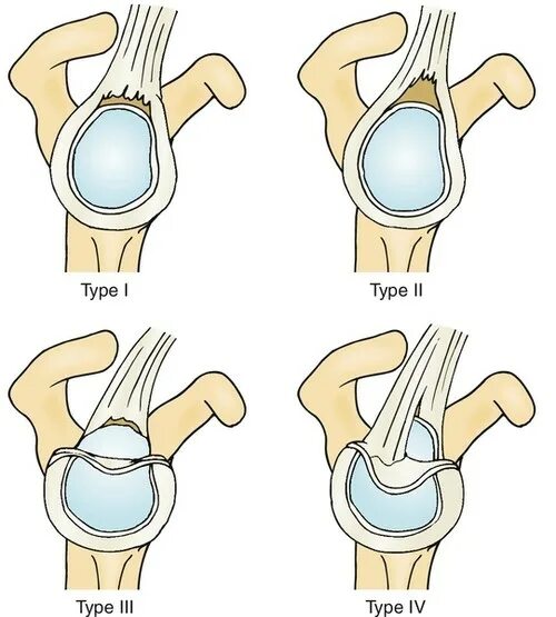Слэп повреждение плечевого сустава. Slap повреждение плечевого сустава классификация.