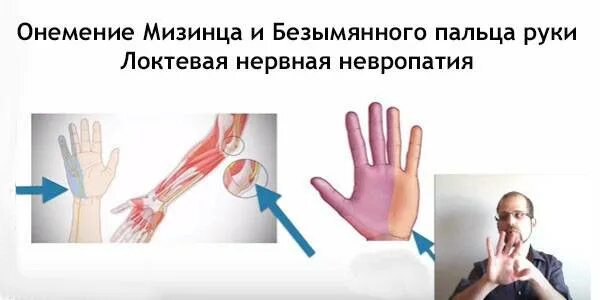 Не чувствую палец. Онемение мизинца и безымянного пальцев. немеет мизинец и безымянный палец. немеет мизинец на левой руке. немеют пальцы на левой руке мизинец.
