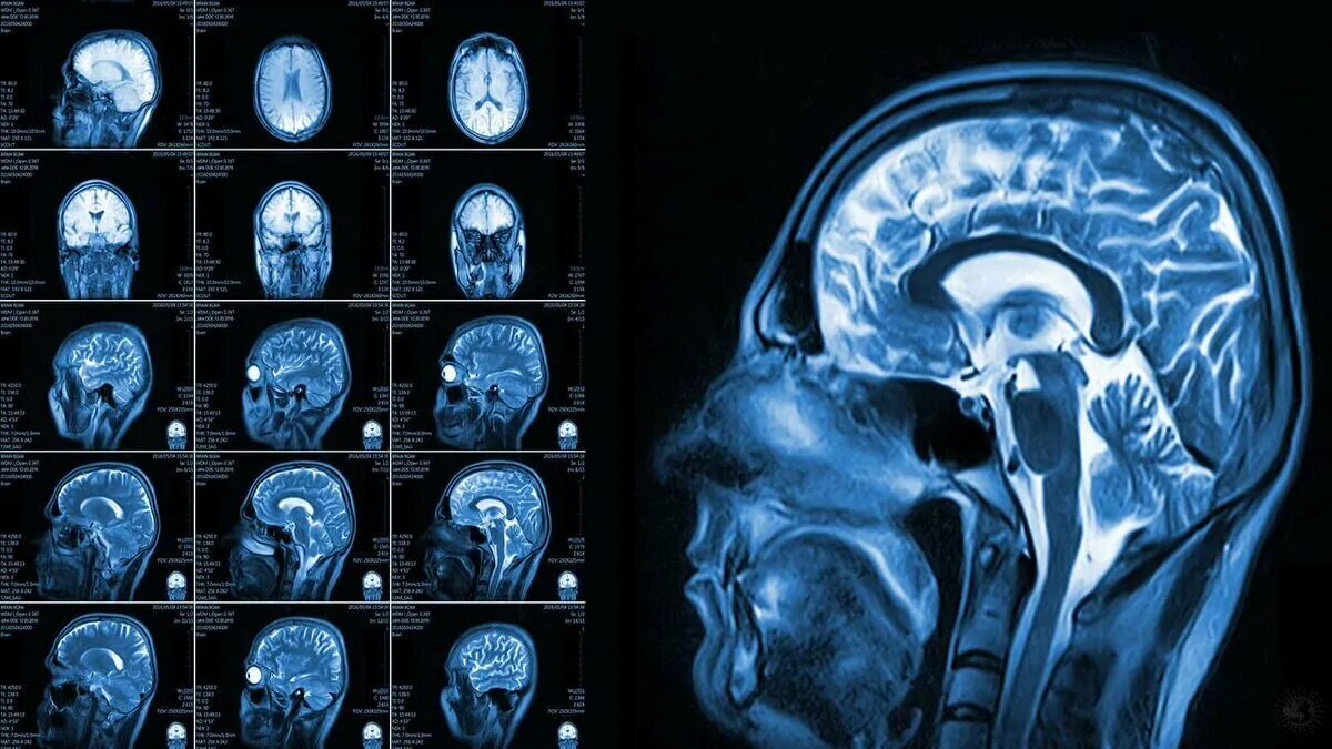 Магнито-резонансная томография головного мозга. Ликворография головного мозга магнитно-резонансная. Мрт головного мозга. Снимки мрт головного мозга.