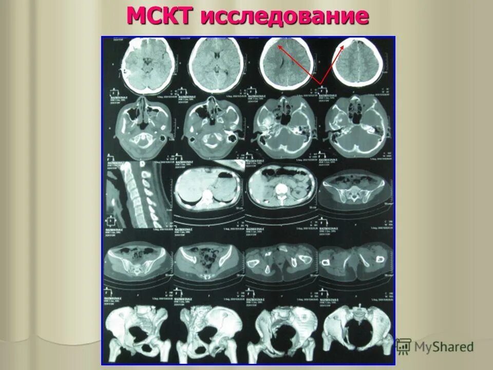 пример диагноза при переломе. задачи по комбинированным травмам. диагноз сочетанная травма. диагноз сочетанная травма. формулировка диагноза сочетанный перелом.