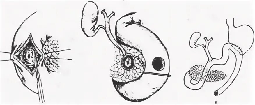 ранние осложнения при резекции желудка. резекция желудка тотальная операция. резекция желудка икота. резекция желудка бильрот 1 и 2. резекция 2/3 желудка по бильрот 1.