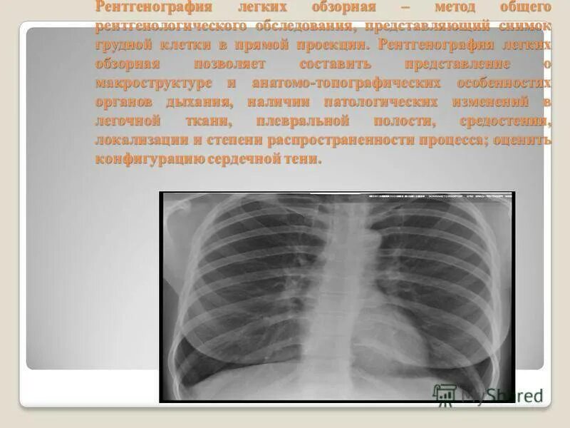 Описание снимков рентгена легких. Обзорная рентгенограмма легких. рентген легких обзорный что это. обзорная рентгенограмма грудной клетки. обзорная рентгенограмма органов грудной клетки.