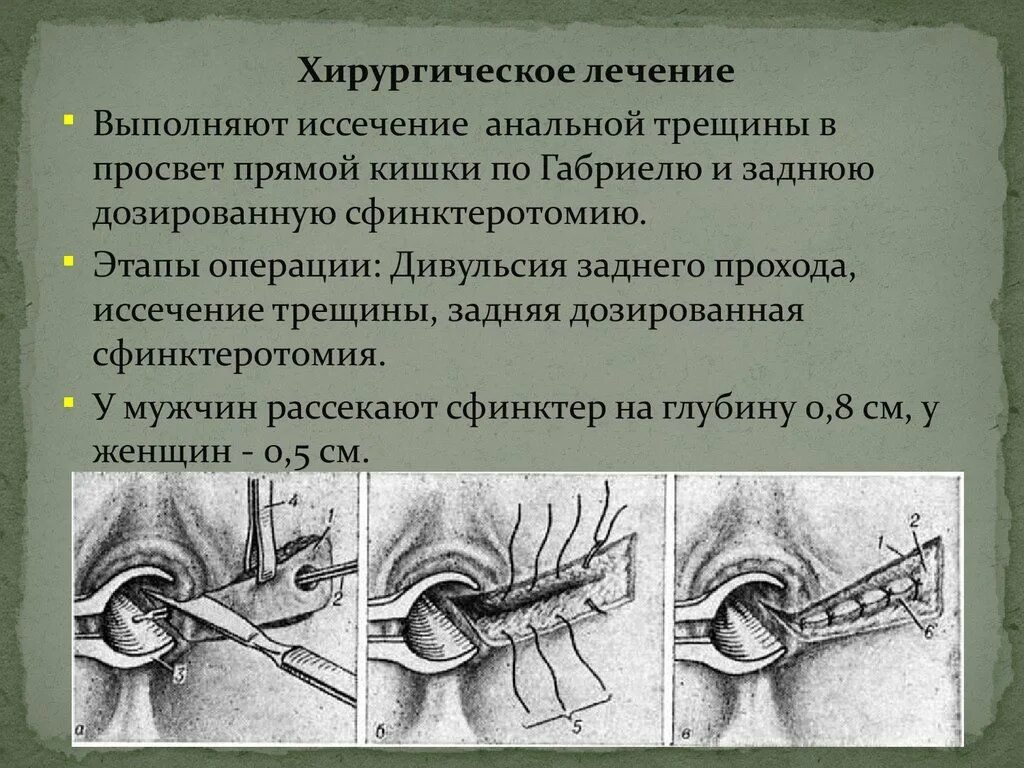 Какие операции делают прямой кишки. Дивульсия сфинктера прямой кишки что это такое. операция по иссечению анальной трещины. анальная трещина лечение.