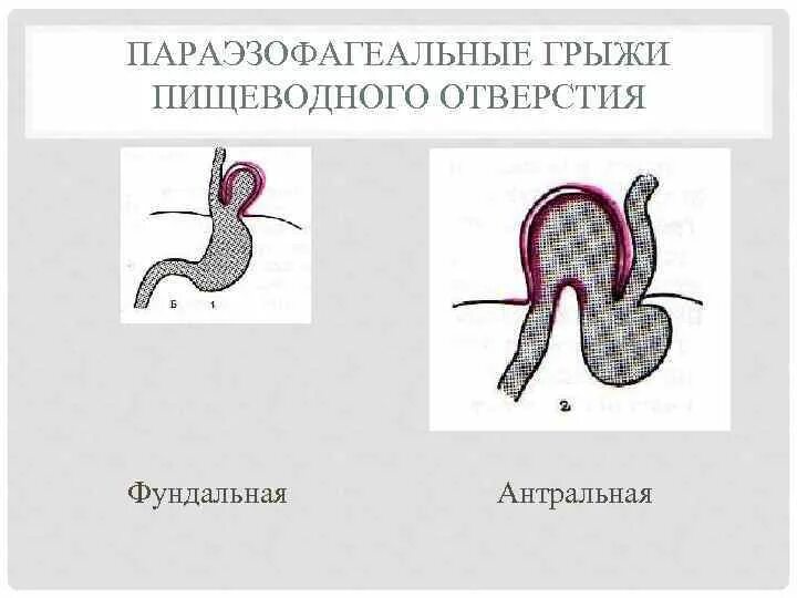 Скользящая грыжа под. Скользящая и Параэзофагеальная грыжа. Параэзофагеальная грыжа под. Параэзофагеальные грыжи пищеводного отверстия. Параэзофагеальная грыжа диафрагмы.