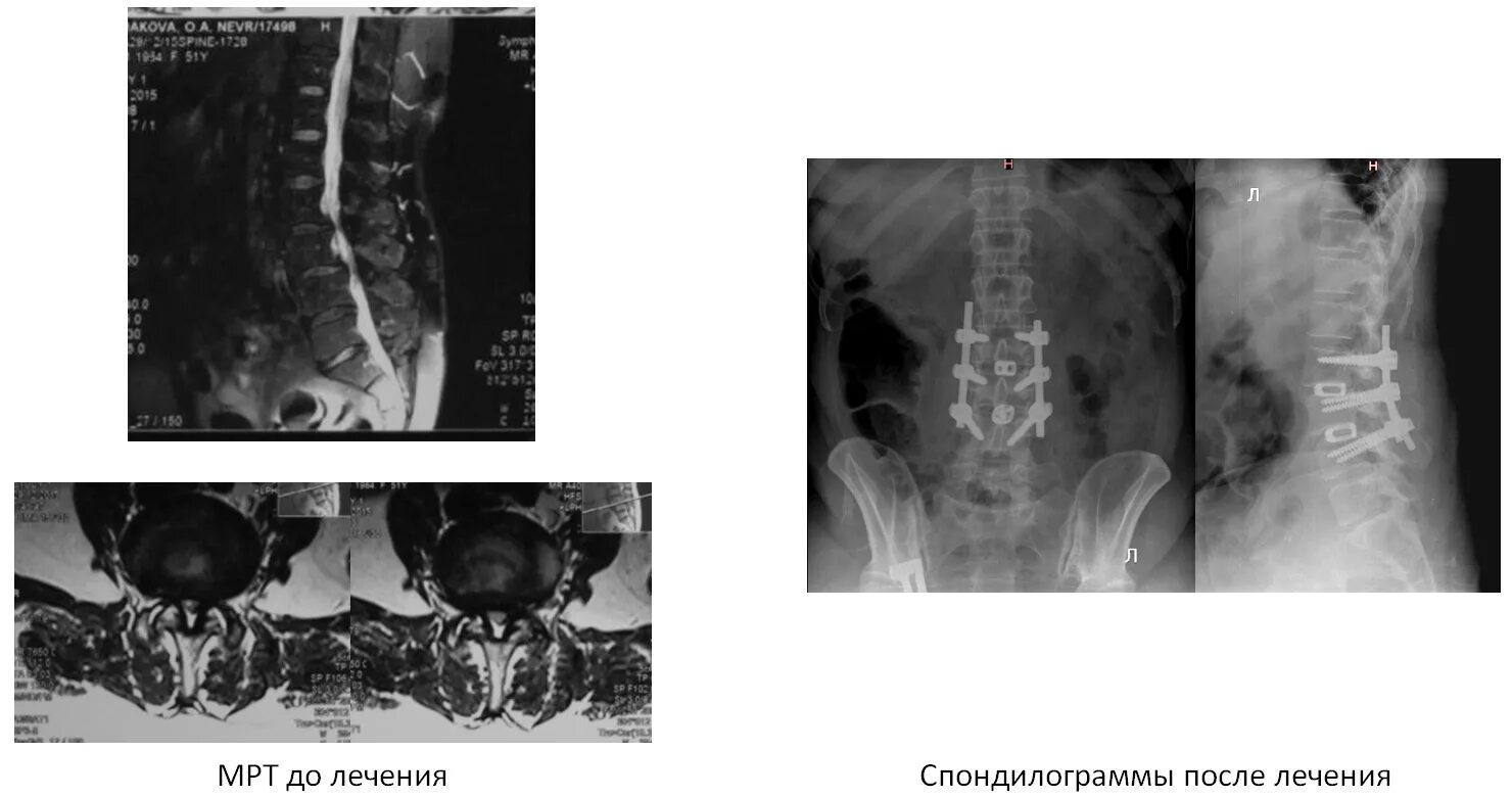 Транспедикулярная фиксация l4 l5 s1. Транспедикулярная фиксация th11-l2. Стабилизация позвоночника операция. Стабилизация позвоночника. Спондилодез l2 s1.