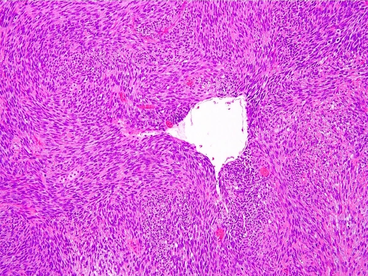 Стромальная саркома. Фибросаркома гистология. Ангиосаркома гистология. Монофазная синовиальная саркома гистология.