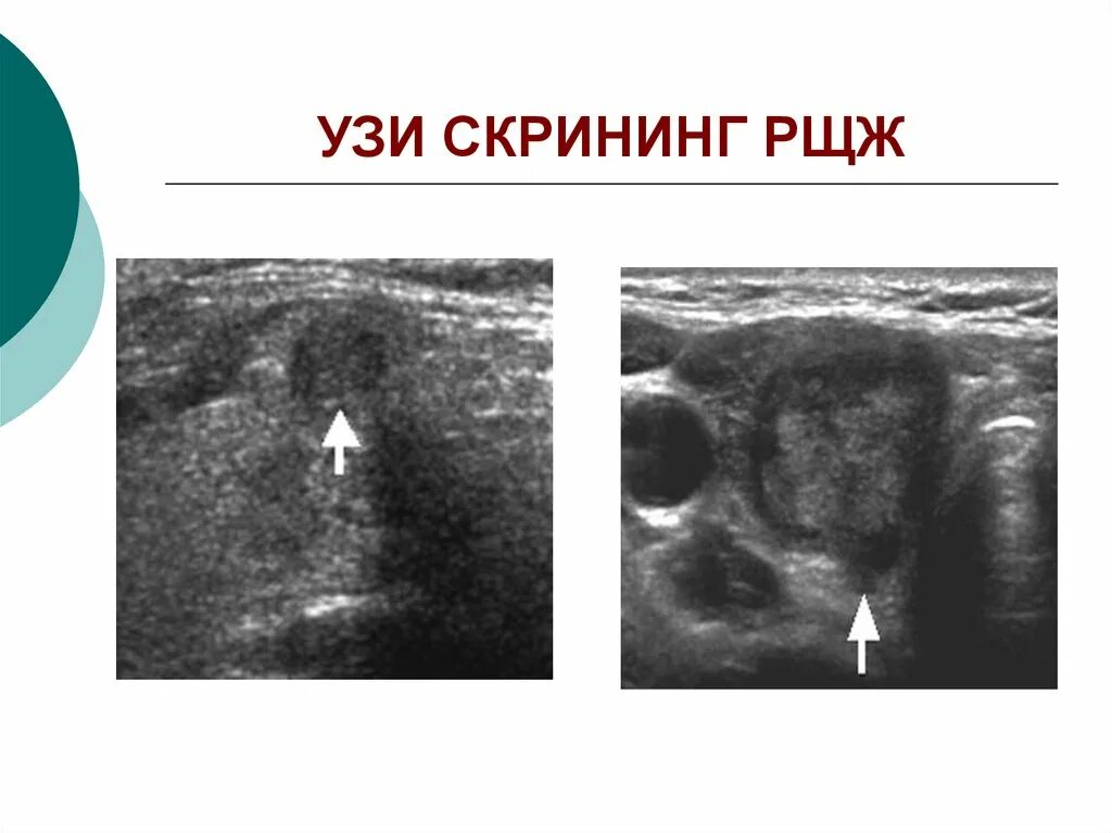 Карцинома щитовидной железы УЗИ. Папиллярная карцинома щитовидной железы УЗИ. Онкология щитовидной железы на УЗИ. Фолликулярная аденома щитовидной железы УЗИ картина.