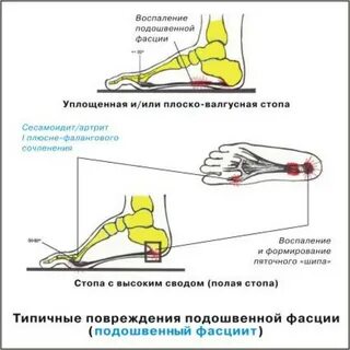 Плантарный фасциит стопы как лечить