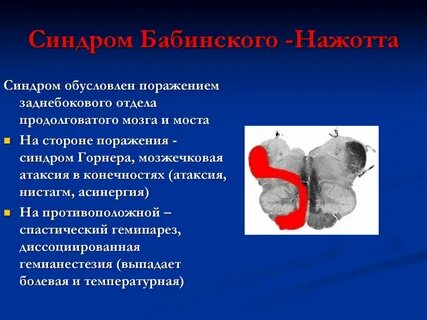 Симптом вебера
