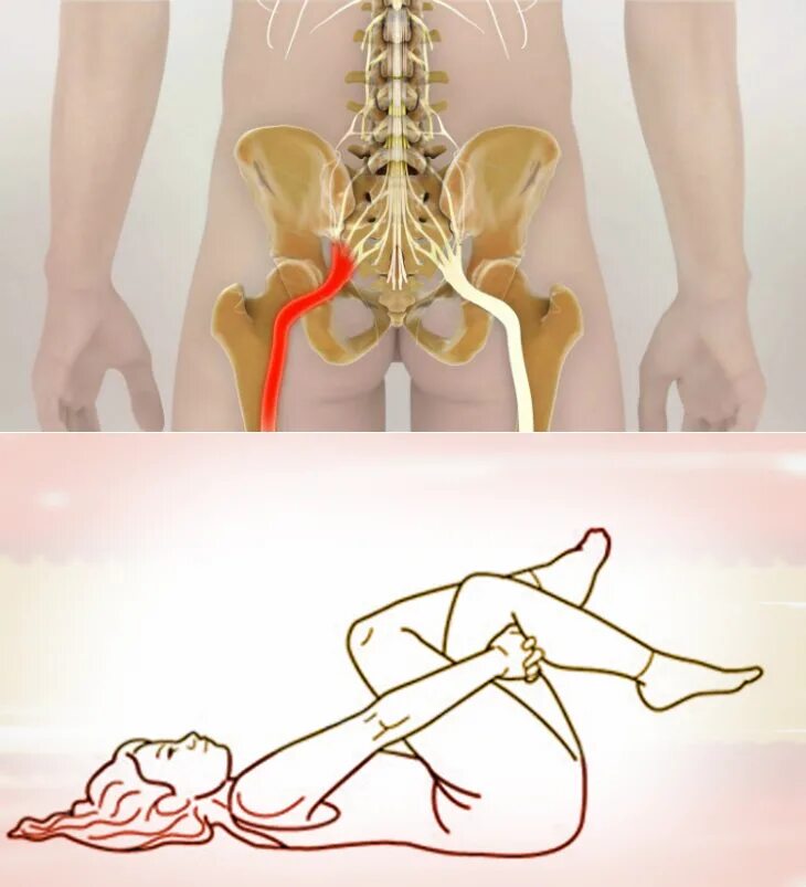 Боли в спине седалищный нерв. Седалищный нерв гимнастика. Защемило седалищный нерв. Защемление седалищного нерва. Ишиас седалищного нерва.
