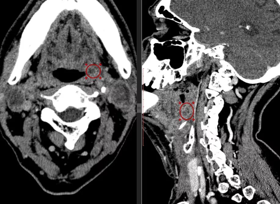 Опухоль щитовидной железы кт.