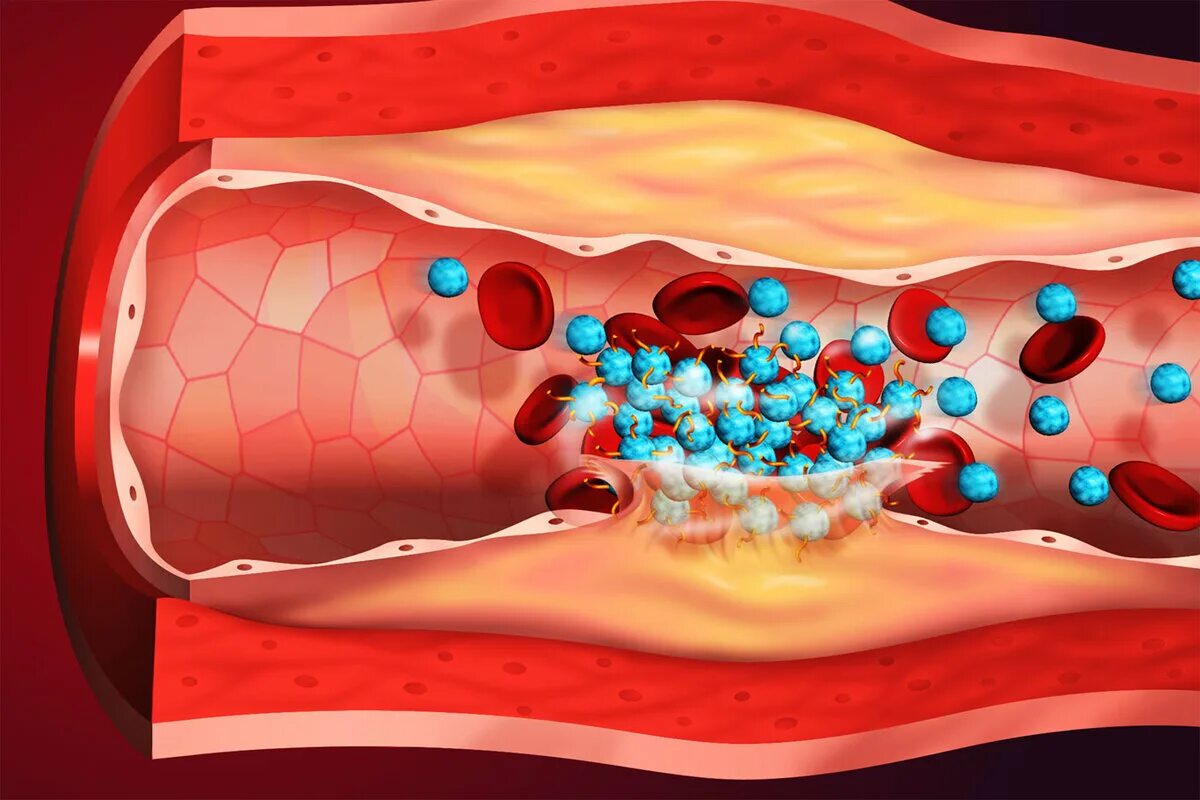 Тромбоз кровеносных сосудов. Образование тромба в сосуде. Кровяной тромб