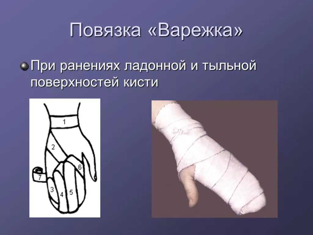 Техника наложения варежки. Наложение повязки варежка. Техника наложения повязки варежка. Наложение повязки на кисть варежка. Наложение повязки варежка алгоритм.