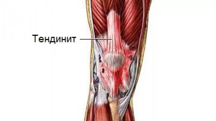 Тендинит связки коленного сустава. Тендинит сухожилия подколенной мышцы. Тендинит сухожилия гусиной лапки коленного сустава. Тендинит сухожилия собственной связки надколенника.