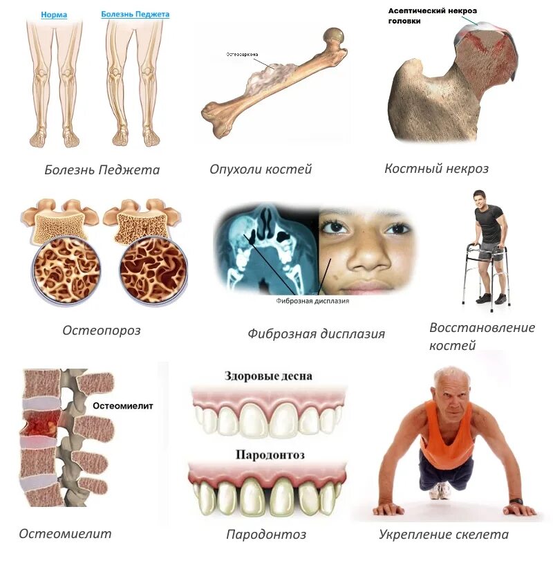 Лечение костных заболеваний. Заболевания костной ткани. Костные заболевания у человека. Стадия восстановления кости.