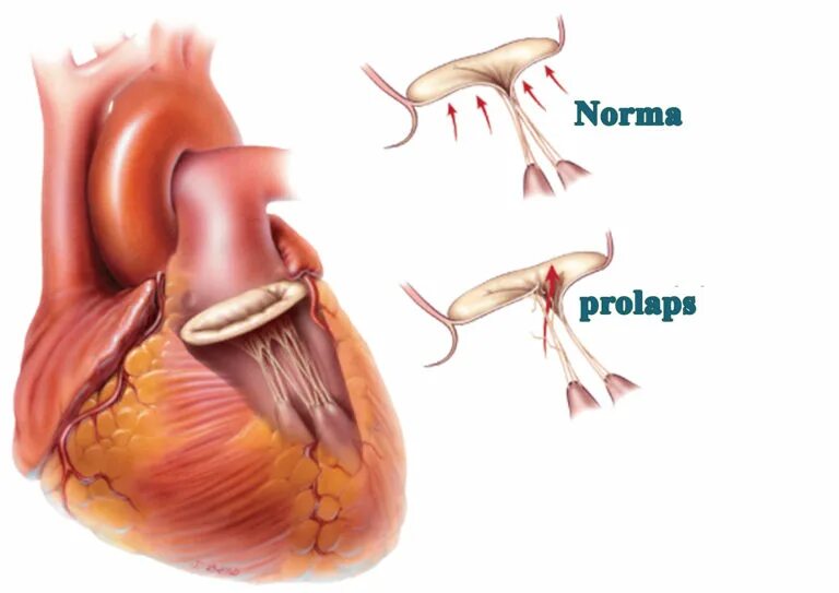 Клапаны сердца. Искусственный клапан сердца. Жизнь с искусственным клапаном сердца форум. Жизнь с искусственным клапаном сердца форум. Искусственный митральный клапан.