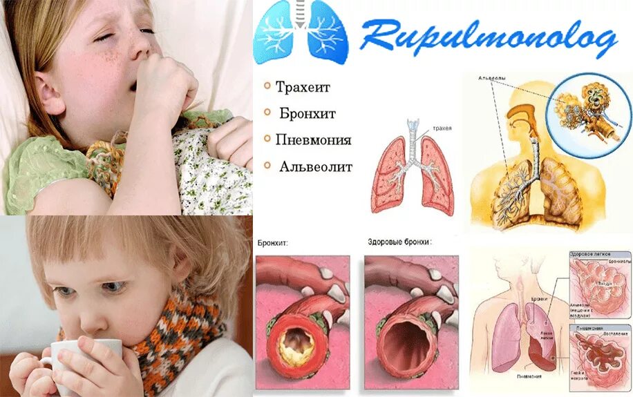 Бронхит сопли. Трахеит кашель у ребенка. Легкий бронхит у ребенка.