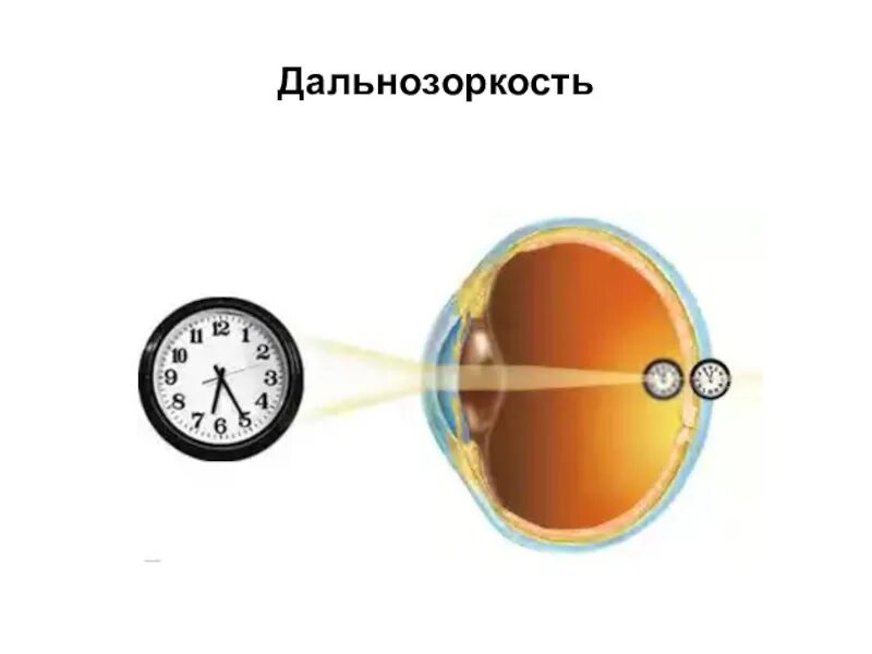 Изображение дальнозоркости