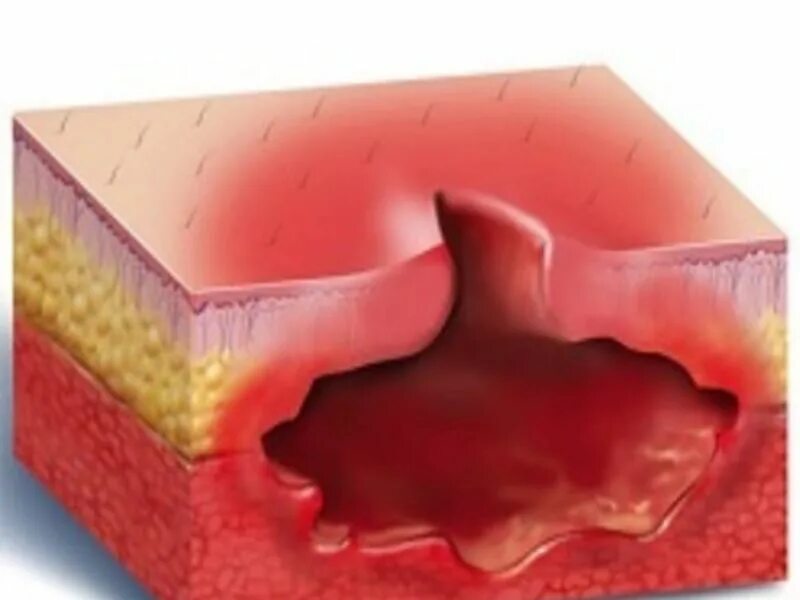 Гнойное воспаление мягких. Декубитальная язва пролежни. Абсцедирующий фурункул.