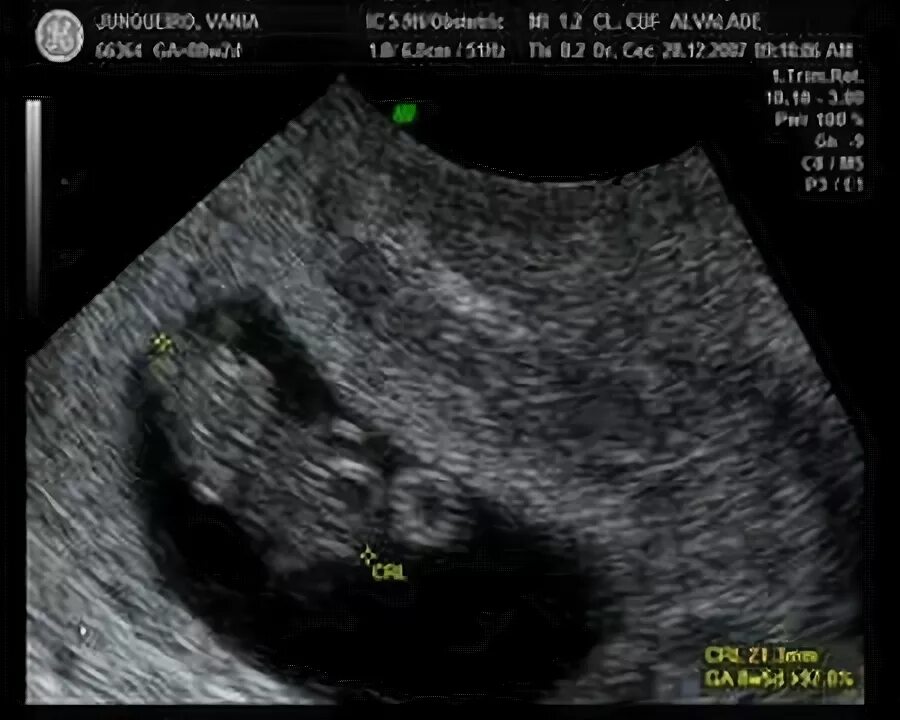 УЗИ 8 недель беременности фото. 8 Недель сосудик. Как выглядит плод на 24 неделе беременности фото. 8 неделя 24 года