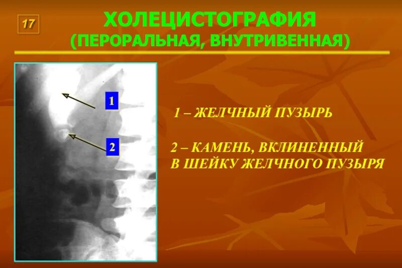 Пероральная холецистография. Холецистография рентгенологическое исследование. Холецистография и холангиография. Внутривенная пероральная холецистография. Ретроградная холецистография.